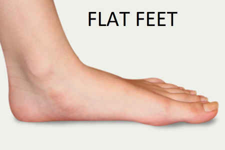 Flat Feet - Sports Massage | Andersons 